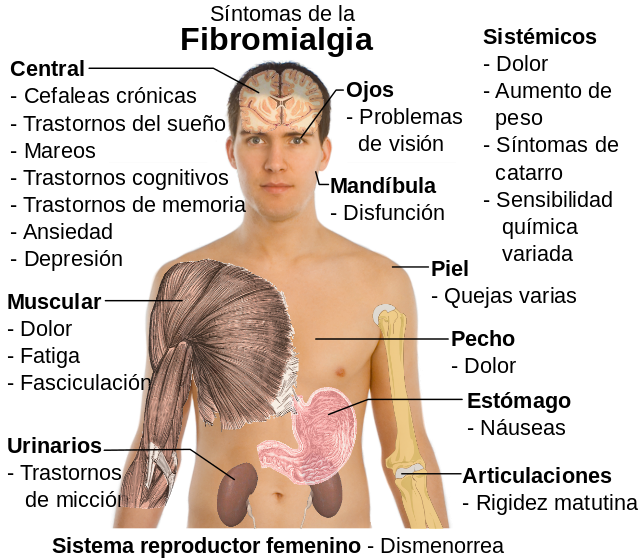 El origen misterioso de la fibromialgia, al descubierto Sintomas_de_la_fibromialgia_es_svg