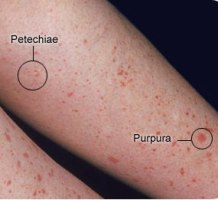 HPV Vaccines and Idiopathic Thrombocytopenic Purpura ITP-1