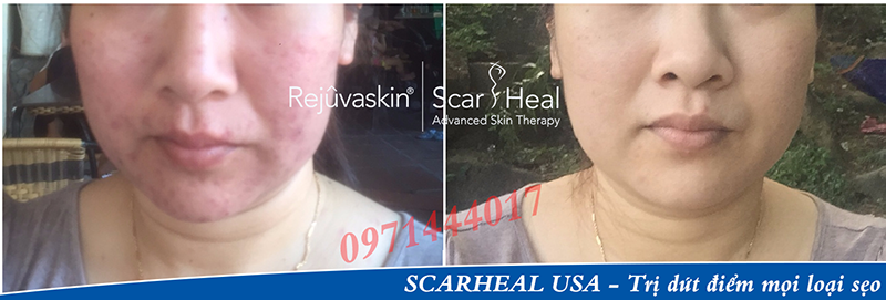 Kem trị sẹo Scar Esthetique có thực sự hiệu quả không? S%E1%BA%B9o-th%C3%A2m(2)