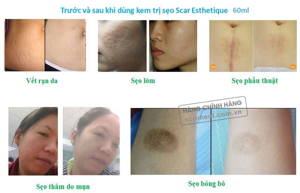 Kem Trị Sẹo Lõm Nào Tốt Nhất Được Các Chuyên Gia Da Liễu Hàng Đầu Mỹ Khuyên Dùng? Scar-heal60ml(4)