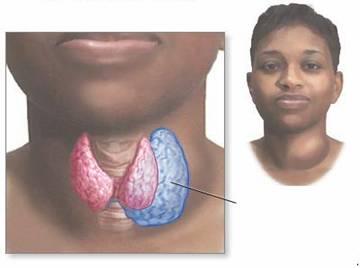 أمراض الغدد الصم Endocrine disorders Goiter