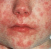  المناعة في الإنسان وأنواع التطعيمات _ Measles1