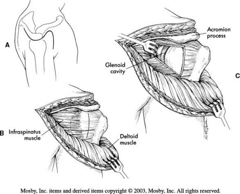 فك الكتف المتكرر Recurrent shoulder dislocation SD