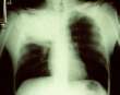 أمراض الجهاز التنفسي Respiratory tract B-pn