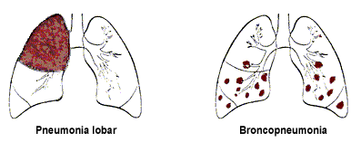 أمراض الجهاز التنفسي Respiratory tract Pn-loc