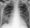 أمراض الجهاز التنفسي Respiratory tract V-pn