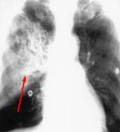 أمراض الجهاز التنفسي Respiratory tract Pnxray