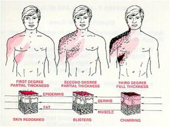  الإسعافات الأولية للحروق First aid for burns Burns-FA14