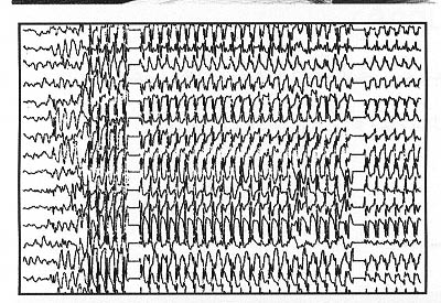 الصرع Epilepsy