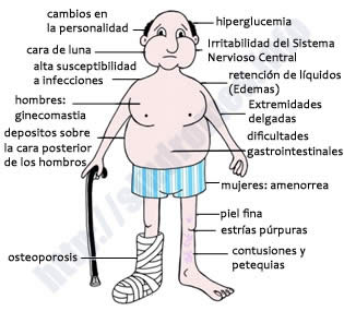 El cortisol Cushing