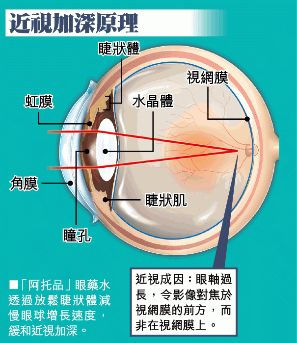 眼藥水+漸進鏡　阻近視加深 A1701a