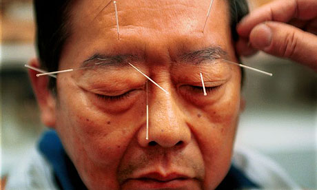 الموسوعه الطبيه ........ماذا تعرف عن الصداع النصفي " الشقيقه " ؟ Acupuncture1