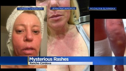 California Fires bring on cluster of mysterious rashes and strange ‘allergic reactions’ Mysterious-rashes-california-fires-july-2018