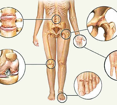 Cerma,shkaqet dhe faktoret e rrezikut Podagra-simptomy