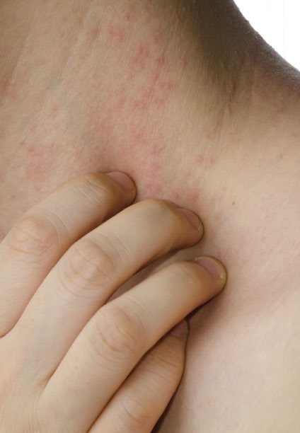 Bệnh chàm là gì ? Benh-cham-da-benh-eczema-thung-bi-nga-4