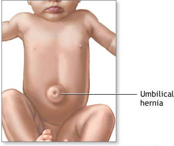 عالم الاطفال Umbilical-hernia