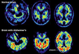 ألزهايمر.. معلومات تهمك Alzheimers-brain1