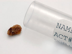 சிறுநீரகக்கல் இருக்கா? கவலையை விடுங்க... 03-kidney-stones-300