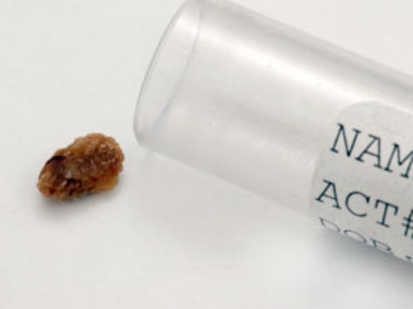 கரும்பின் நன்மைகள்!!! 11-1357886115-kidneystones