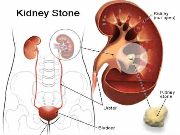 வாழைப்பழம் சாப்பிடுவதால் கிடைக்கும் நன்மைகள்!!! 22-1369207626-15-kidneystone