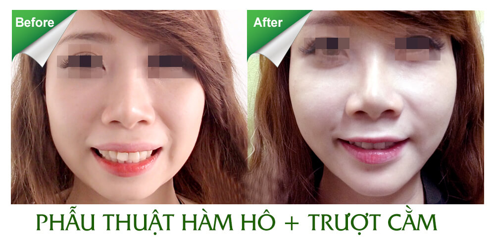 Phẫu thuật chữa cười uy tín tại tp.HCM PT-h%C3%A0m-h%C3%B4-tr%C6%B0%E1%BB%A3t-c%E1%BA%B1m