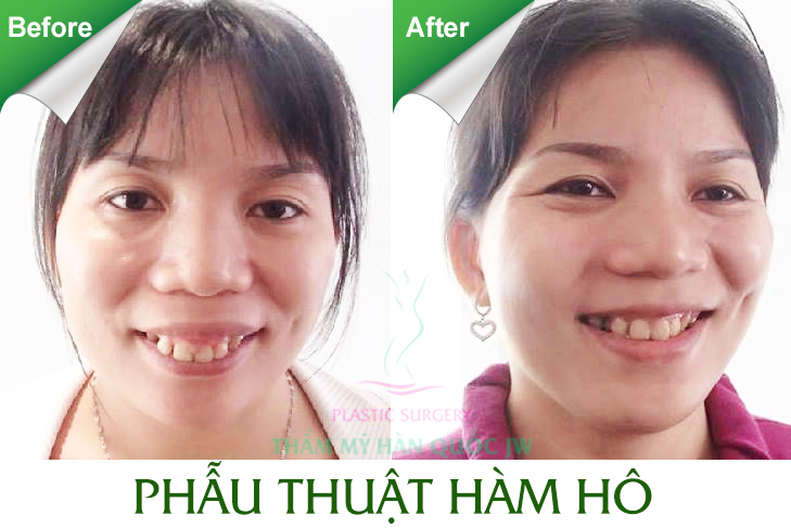 Review chỉnh răng hàm hô bằng phẫu thuật mới 2016 Hamho11