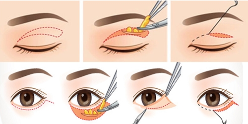 Phương pháp lấy mỡ mí mắt và cắt da thừa siêu đơn giản Lay-mo-mi-mat1