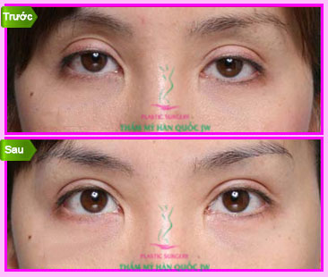 Phương pháp lấy mỡ mí mắt và cắt da thừa siêu đơn giản Lay-mo-mi-mat2