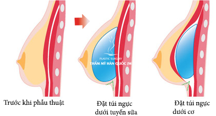 Chi phí cho nâng ngực nội soi là nhiêu ? Chi-phi-nang-nguc-noi-soi-01