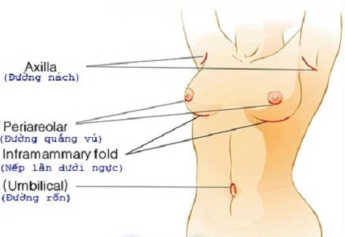 Những điều cần biết về phẫu thuật nâng ngực Phau-thuat-nang-nguc-nhung-dieu-can-biet-5