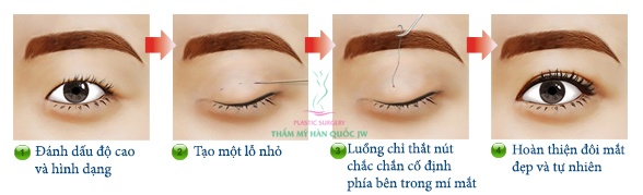 Bấm mí mắt uy tín ở đà nẵng ? Bam-mi-613