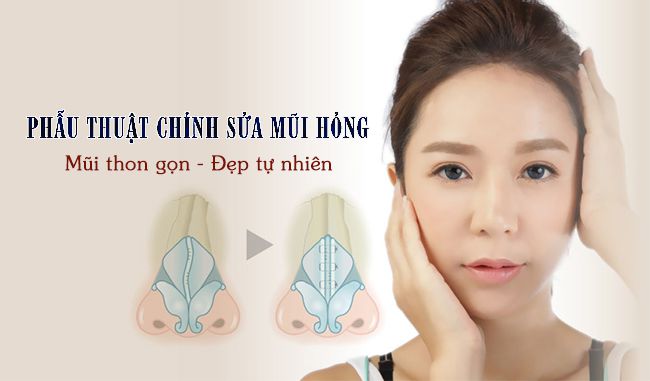 Nâng mũi bao lâu thì sửa lại được? Vienthammyvip Chinh%20sua%20mui%20hong