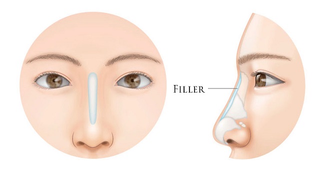 Tiêm filler có tác hại gì không - Thẩm Mỹ VIP Nang-mui-filler-co-nguy-hiem-khong-1