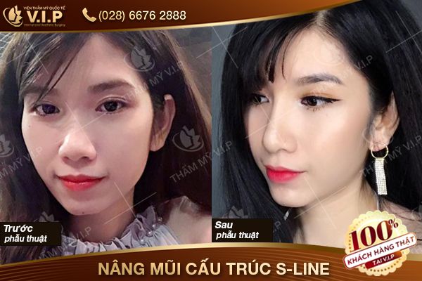 Có nên nâng mũi không - thẩm mỹ viện vip Khach-hang-nang-mui-cau-truc-s-line-2