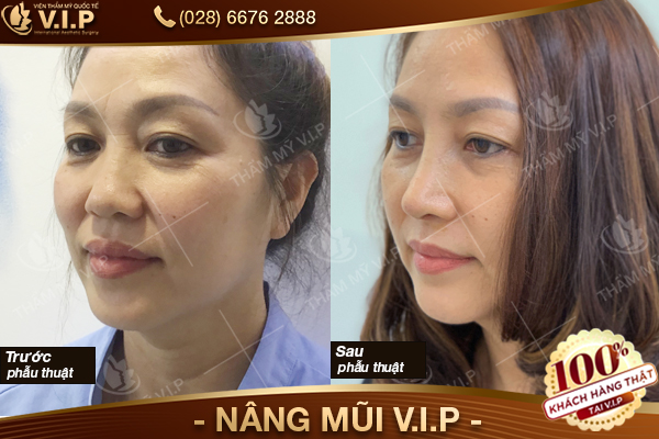  Làm sao cho cánh mũi nhỏ lại? Khach-hang-nang-mui-vip-22