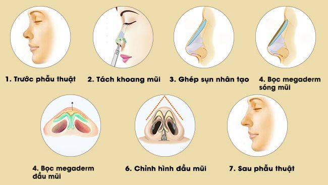 Nâng mũi bọc sụn megaderm ở đâu đẹp? Quy-trinh-nang-mui-boc-sun-megaderm