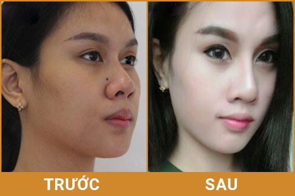 Chăm sóc sau nâng mũi thế nào cho đúng cách? Lam-the-nao-cham-soc-sau-nang-mui-dung-cach-3