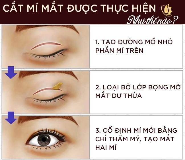 Cách chăm sóc mắt sau khi cắt mí để có đôi mắt đẹp Cat-mi-mat-thuc-hien-nhu-the-nao