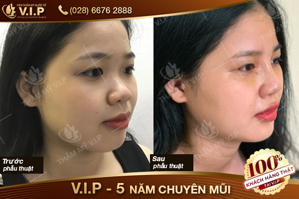 Sau khi nâng mũi nên ăn gì? Viện thẩm mỹ vip Khach-hang-nang-mui-t7-13