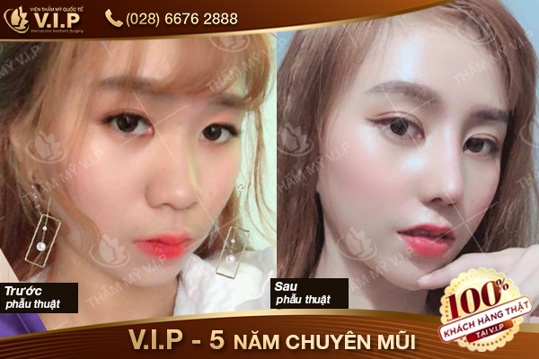 Khuyến mãi thẩm mỹ - mừng sinh nhật vip giảm 50% Khach-hang-nang-mui-t7-16