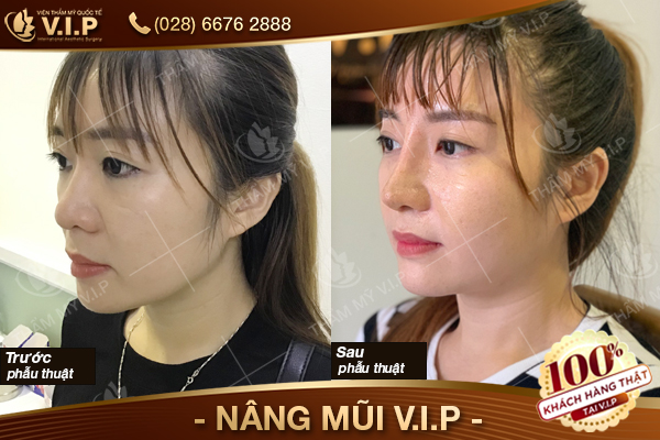  Nâng mũi bán cấu trúc sụn tai là như thế nào Nang-mui-vip-thang-9-5