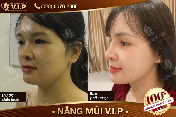 Phẫu thuật nâng mũi bán cấu trúc sụn tai là gi? Nang-mui-vip-thang-9-7