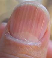 The Truth about Your Nails! Nail-ridges-2