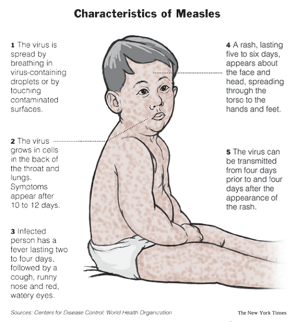 Europa debe tomar medidas para prevenir brote de sarampión en el año 2012 continuó 20060430_MEASLES.2_575x623