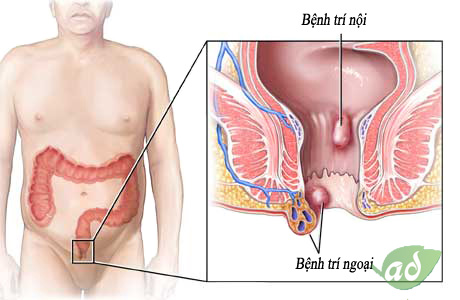 Giải đáp bệnh trĩ có gây đau lưng không Benh-tri-ngoai