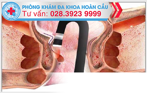 Căn bệnh trĩ hỗn hợp giai đoạn nào có khả năng mổ trĩ bằng biện pháp laser Chua-tri-benh-tri-hon-hop-bang-tia-laser