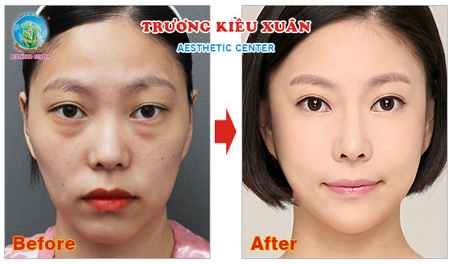 Căng da mặt bằng chỉ Collagen - Nét Xuân còn mãi với thời gian Image013