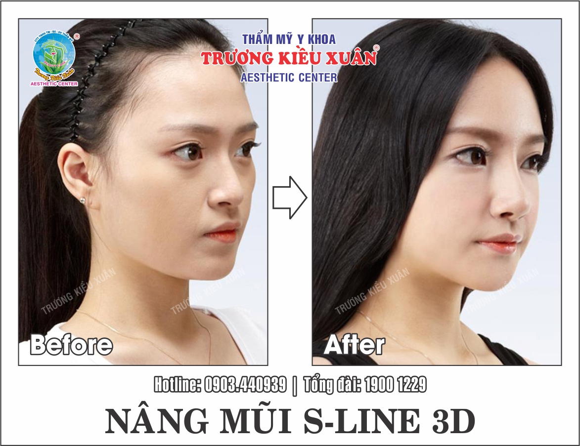 Nâng mũi S line 3D hiệu quả như thế nào? Nang-mui-S-line-3D-truoc-sau