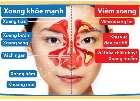 Một số vấn đề phải lưu tâm trong khi điều trị viêm xoang mũi VIEM-XOANG