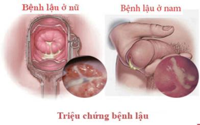 Sức khỏe, đời sống: Bệnh lậu có triệu chứng là gì bạn có biết? 21517452842